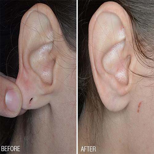 Ear Lobe Repair near me